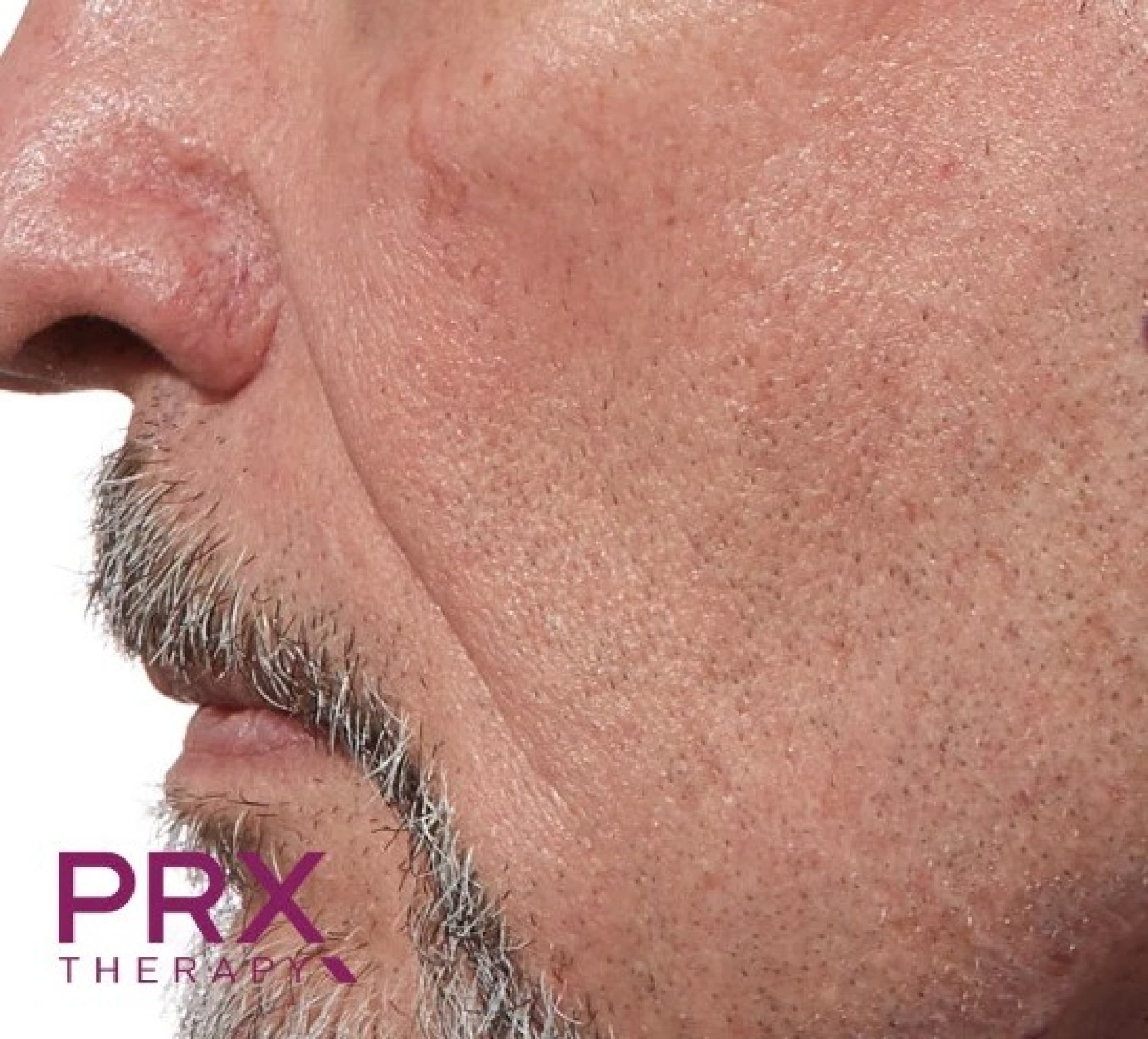 PRX-neulaton biorevitalisaatio 30 min | Helsinki | Elamyslahjat
