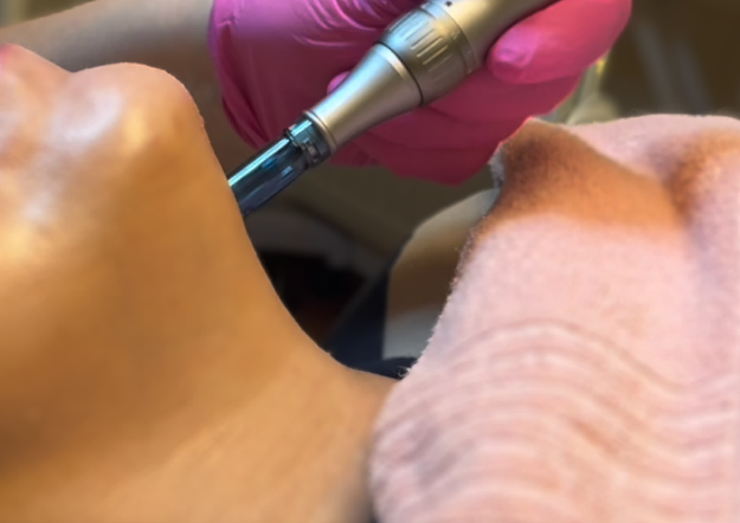 BIOAGE kollageenisilkkilankakohotus nano-mikroneulauksella | Järvenpää