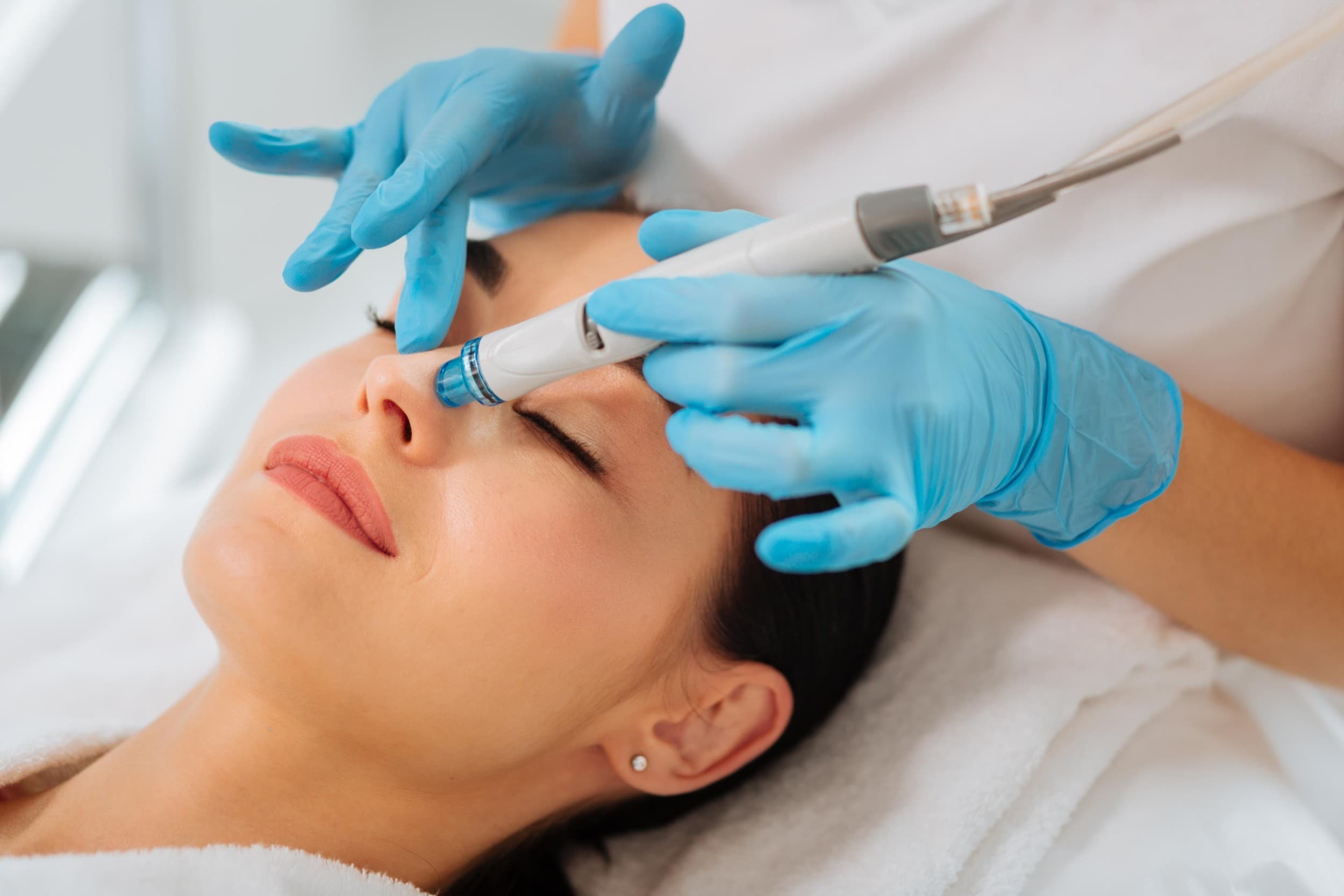 Nasolabiaalijuonteiden täyttö | Helsinki